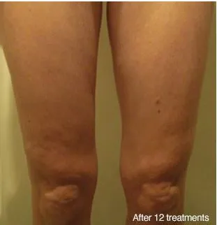 A patient's slimmed down legs after 12 treatments