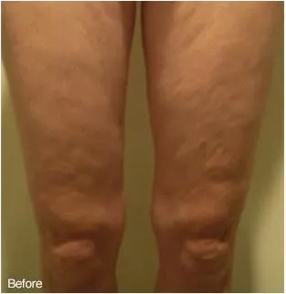 A patient's legs before treatments