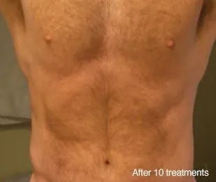 A patient's toned torso after 10 treatments