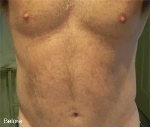 A patients torso before treatment